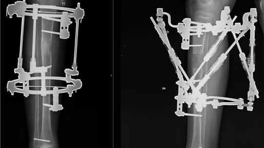 Ekstremitāšu asimetrijas un deformāciju korekcija